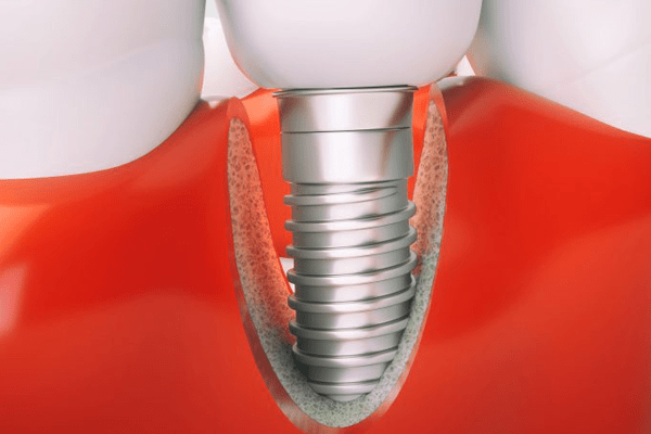  Peri-implantitis successfully treated with new procedure